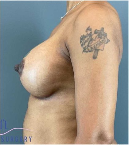 Breast Augmentation Before & After Patient #1296