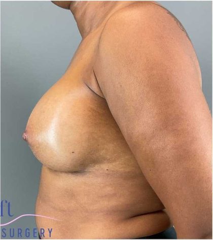 Breast Augmentation Before & After Patient #1307
