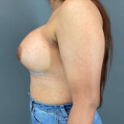 Breast Augmentation Before & After Patient #1318