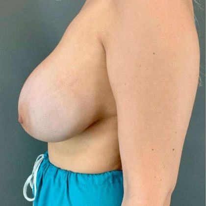 Breast Augmentation Before & After Patient #1384
