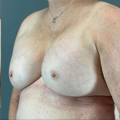 Breast Augmentation Before & After Patient #1450