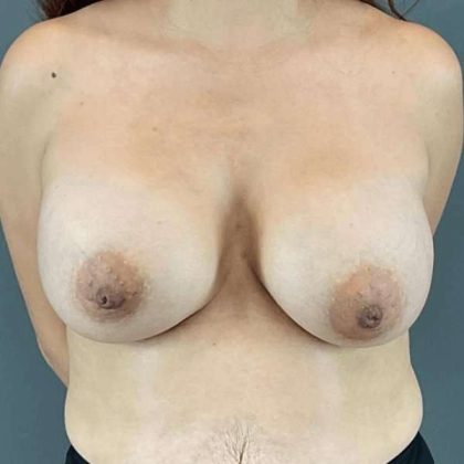 Breast Augmentation Before & After Patient #1461