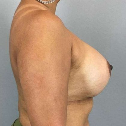 Breast Augmentation Before & After Patient #1483