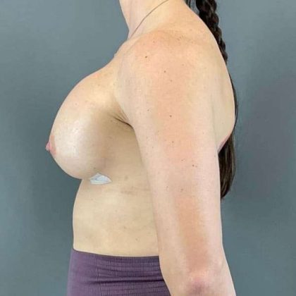 Breast Augmentation Before & After Patient #1547