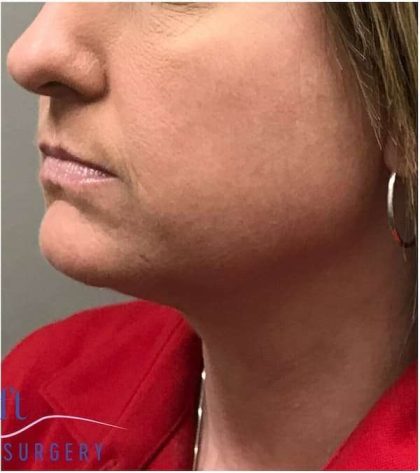 Necktite Before & After Patient #1624