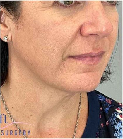 Necktite Before & After Patient #1633