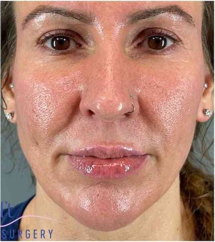 Necktite Before & After Patient #1642