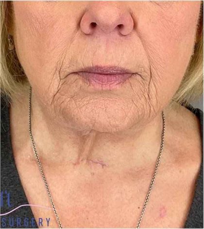 Neck Lift Before & After Patient #1649