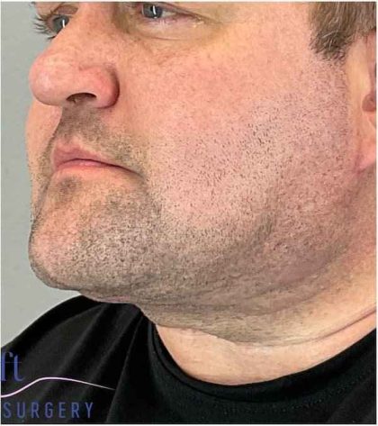 Neck Lift Before & After Patient #1660