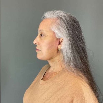 Neck Lift Before & After Patient #1671
