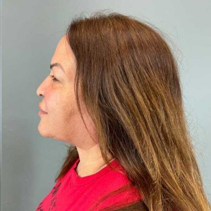 Neck Lift Before & After Patient #1678