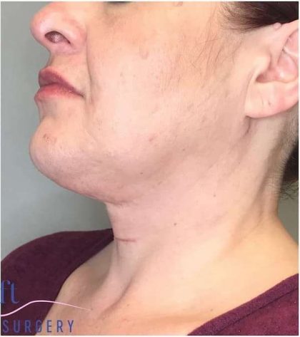 Neck Lift Before & After Patient #1696