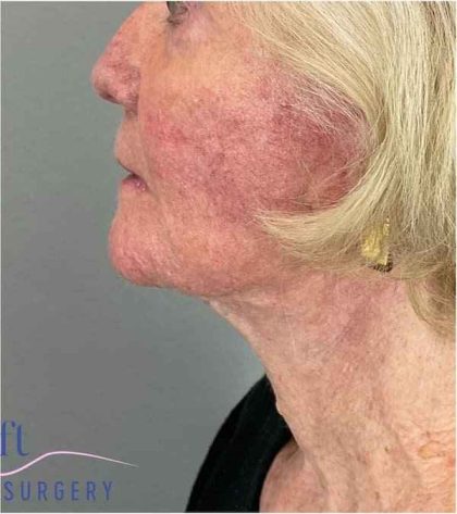 Facelift Before & After Patient #1703
