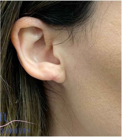Ear Surgery Before & After Patient #1708