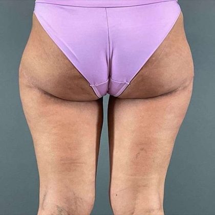 Thigh Lift Before & After Patient #233