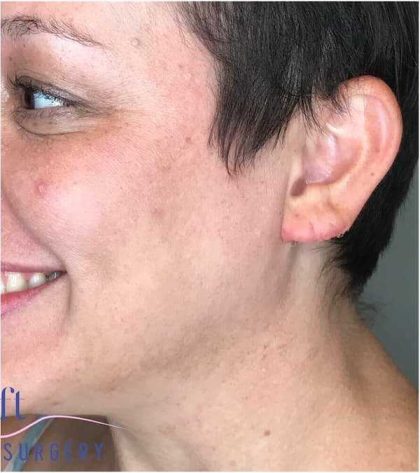 Ear Surgery Before & After Patient #1724