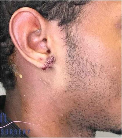 Ear Surgery Before & After Patient #1731