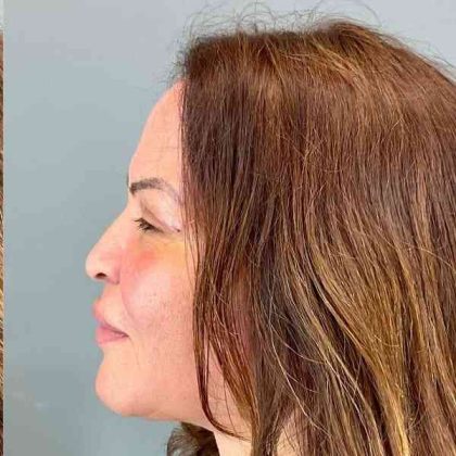 Eyelid Surgery Before & After Patient #1754