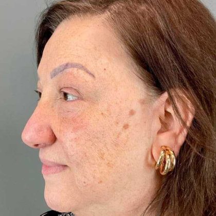 Eyelid Surgery Before & After Patient #1761