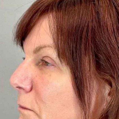 Eyelid Surgery Before & After Patient #1768