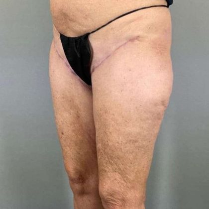 Thigh Lift Before & After Patient #240