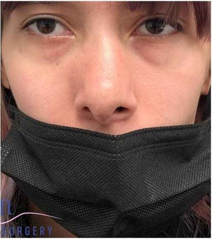 Rhinoplasty Before & After Patient #1796