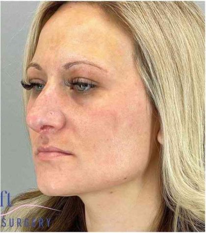 Rhinoplasty Before & After Patient #1807