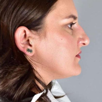 Rhinoplasty Before & After Patient #1818