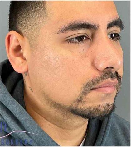Rhinoplasty Before & After Patient #1825