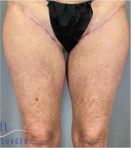 Thigh Lift Before & After Patient #247