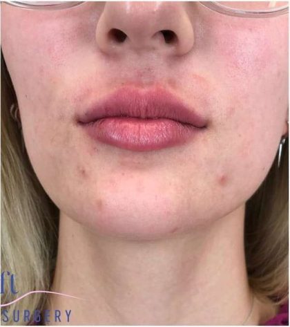 Injectables&Fillers Before & After Patient #130