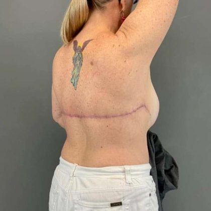 Back Lift Before & After Patient #287