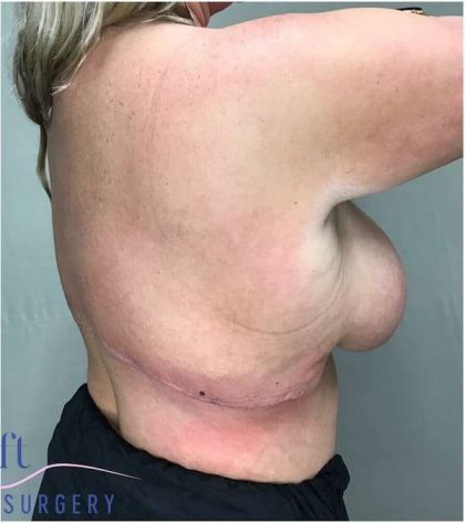 Back Lift Before & After Patient #292