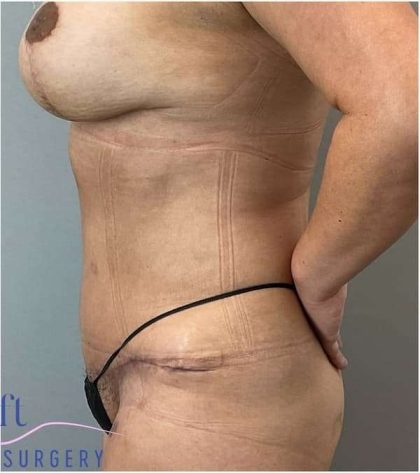 Tummy Tuck Before & After Patient #303