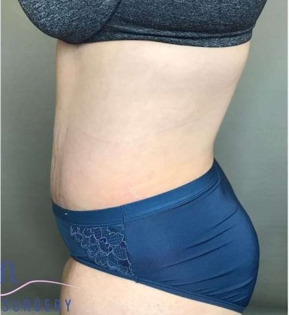 Tummy Tuck Before & After Patient #314