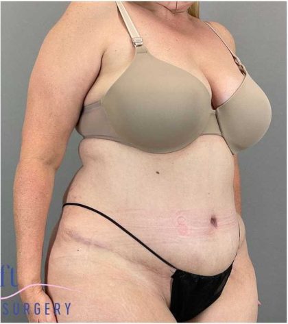 Tummy Tuck Before & After Patient #325