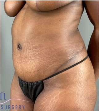 Tummy Tuck Before & After Patient #332