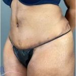 Tummy Tuck Before & After Patient #346