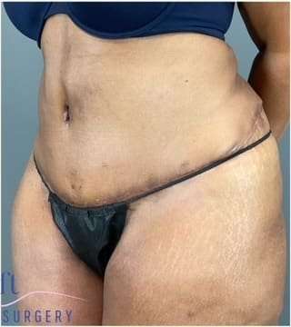 Tummy Tuck Before & After Patient #346