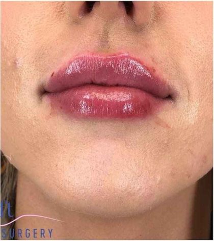 Injectables&Fillers Before & After Patient #135