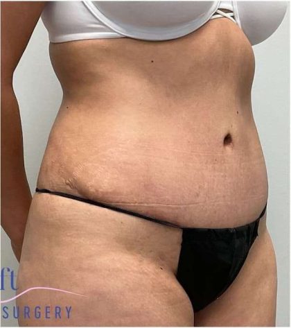 Tummy Tuck Before & After Patient #357