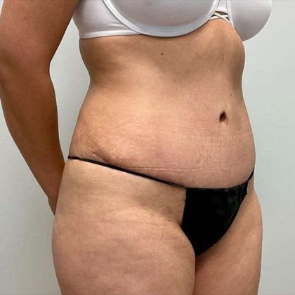 Tummy Tuck Before & After Patient #379