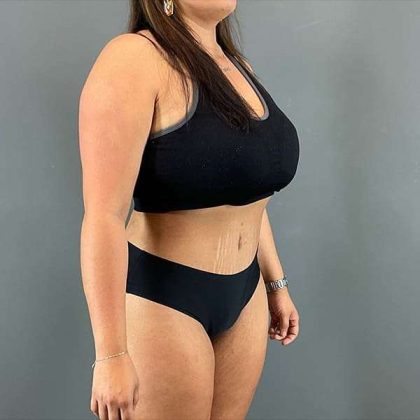 Tummy Tuck Before & After Patient #390