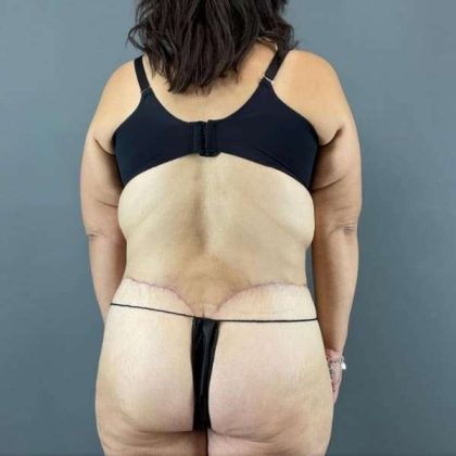 Tummy Tuck Before & After Patient #401