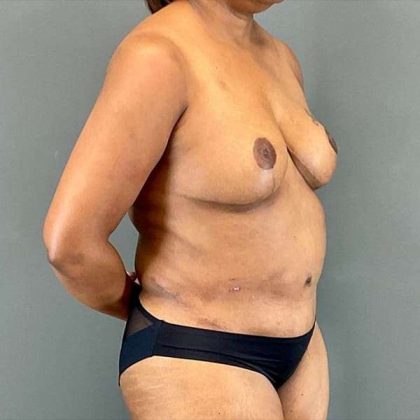 Tummy Tuck Before & After Patient #412
