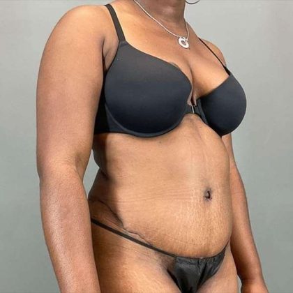 Tummy Tuck Before & After Patient #423