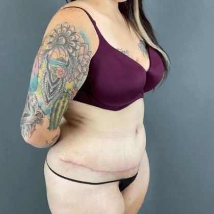 Tummy Tuck Before & After Patient #434