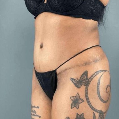 Tummy Tuck Before & After Patient #454
