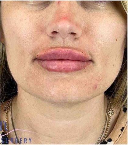 Injectables&Fillers Before & After Patient #140