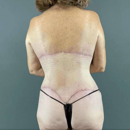 Tummy Tuck Before & After Patient #465